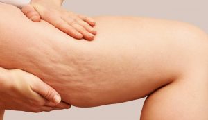 Cellulite