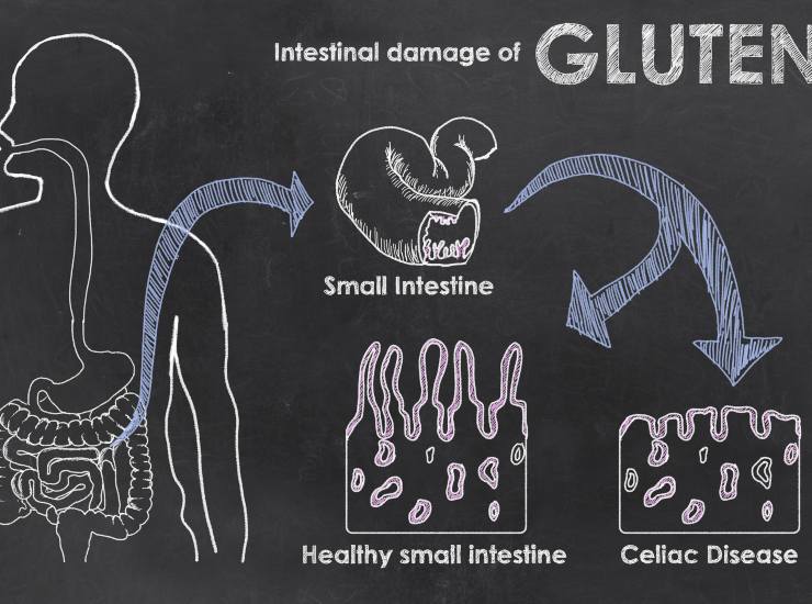 I danni del glutine nei celiaci e negli intolleranti