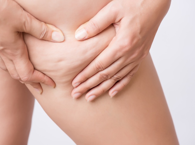 La ritenzione idrica causa la cellulite rimedi