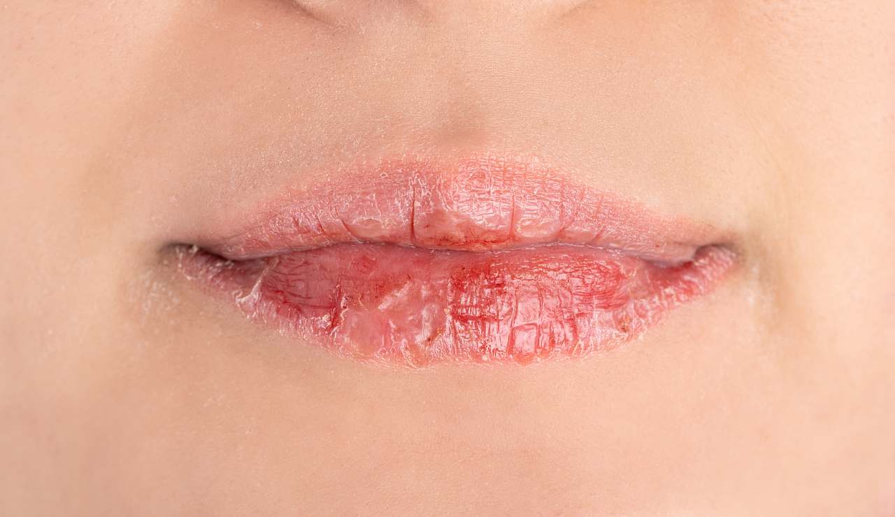 Labbra secche e screpolate, cosa significa