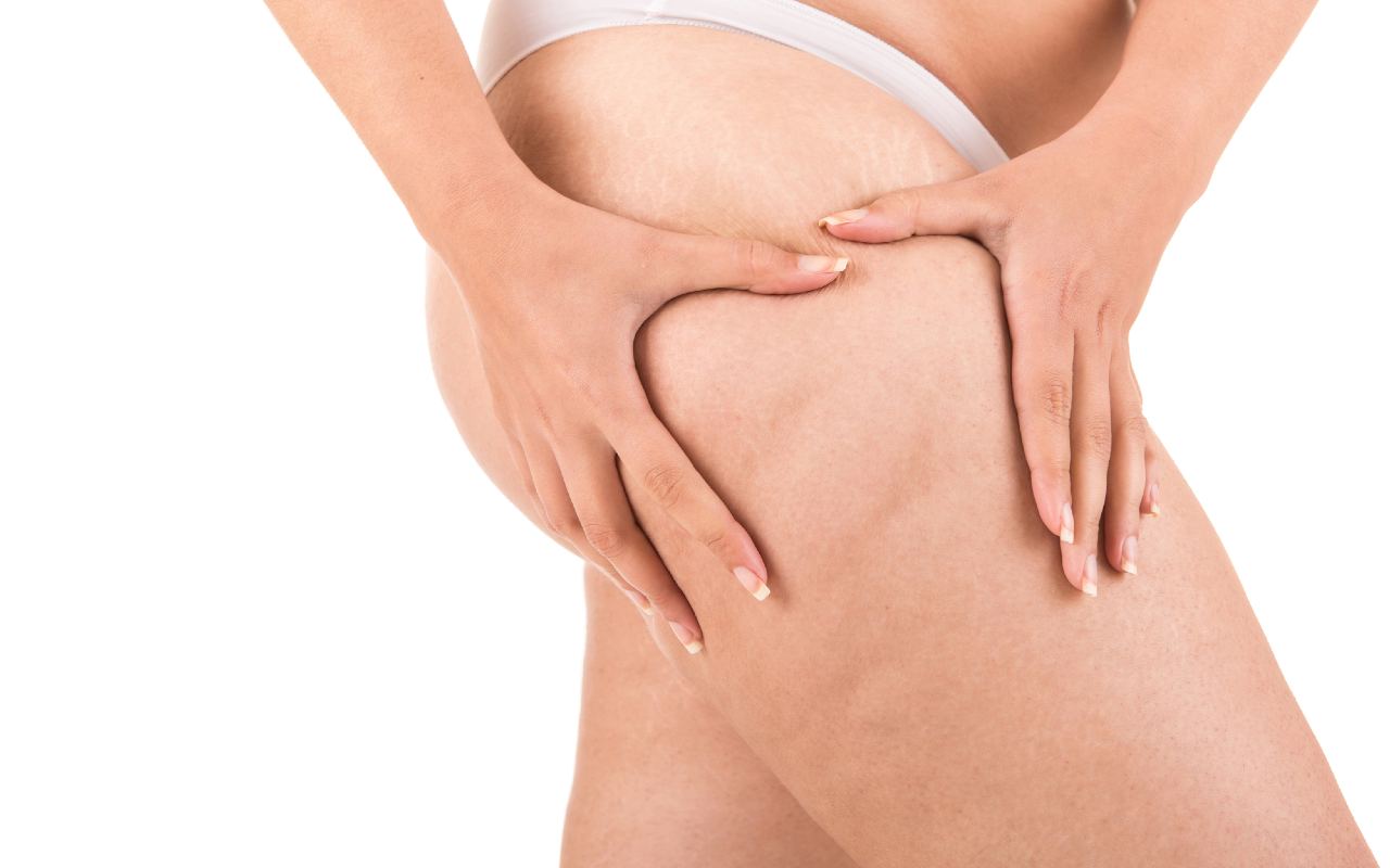 Come combattere la cellulite