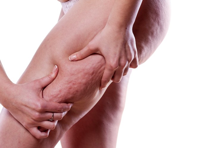 Come combattere la cellulite